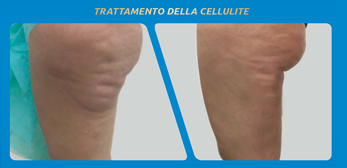 Cellulite - Pre e Post Criolipolisi - Caradel Macerata